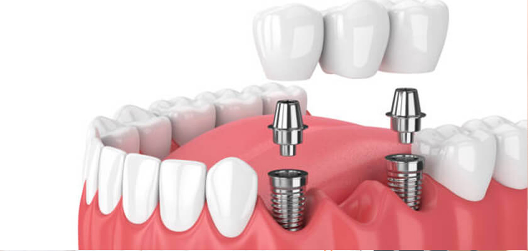 Prosthodontics